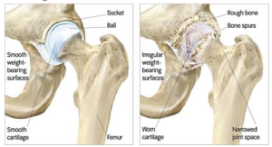 Hip Osteoarthritis Jason H Tam M D